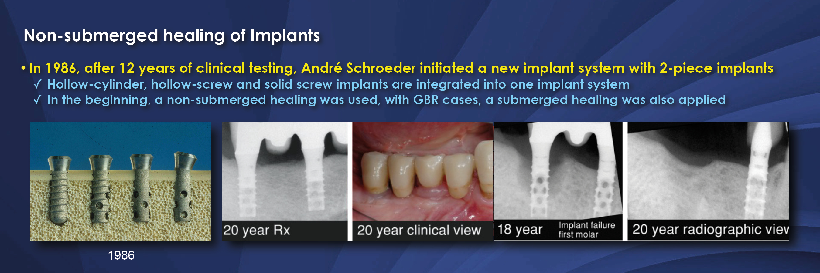Oral Implantology: Basics， ITI Hollow Cylinder System (Thieme